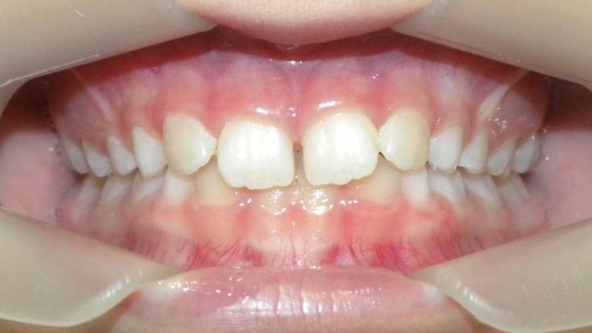 Frontal (Oclusión)