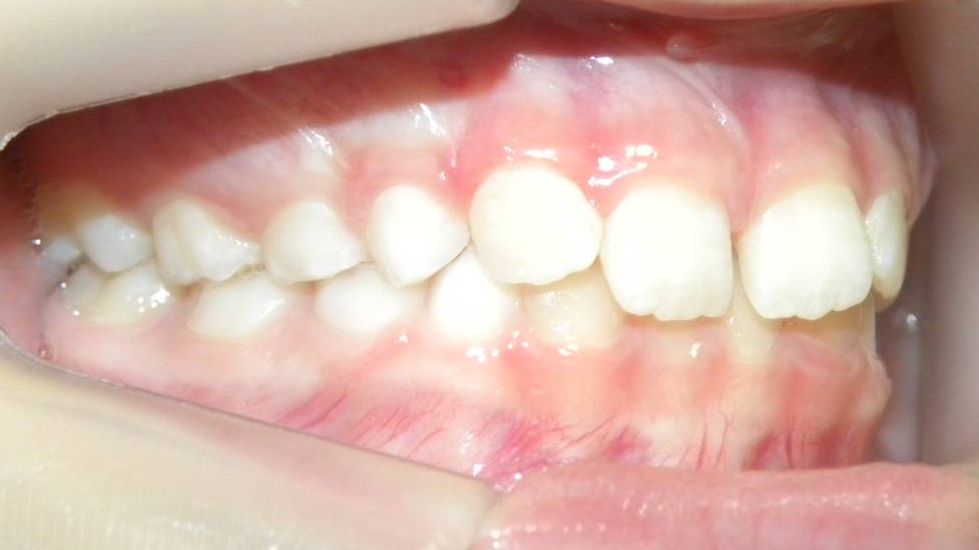 Lateral Derecha
