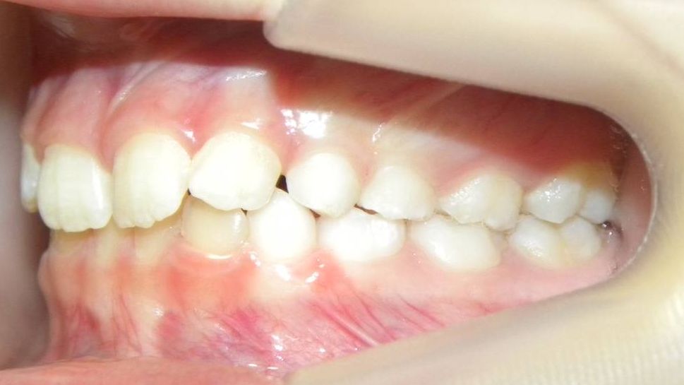 Lateral Izquierda