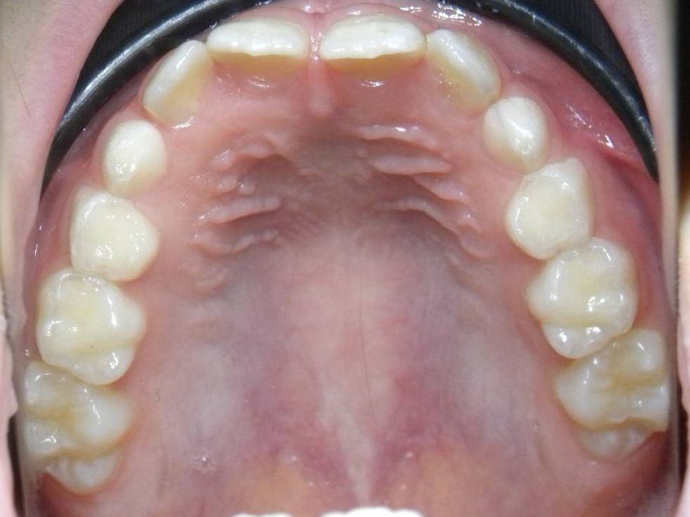 Oclusal Superior