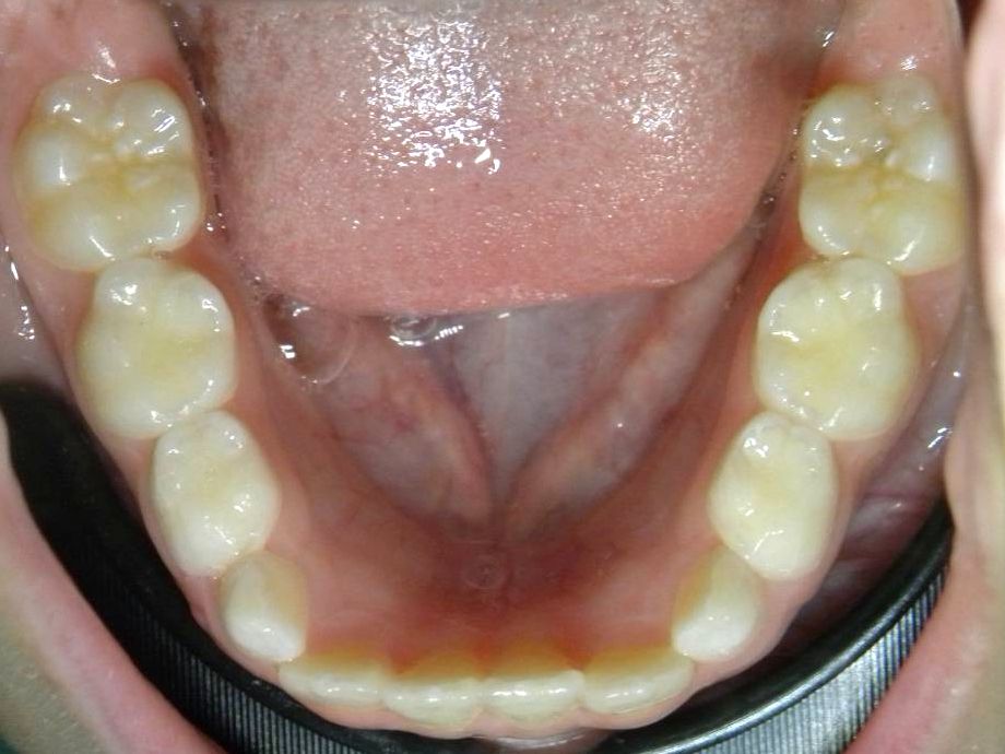 Oclusal Inferior