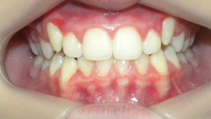 Frontal (Oclusión)