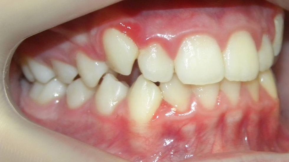 Lateral Derecha