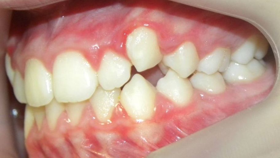 Lateral Izquierda