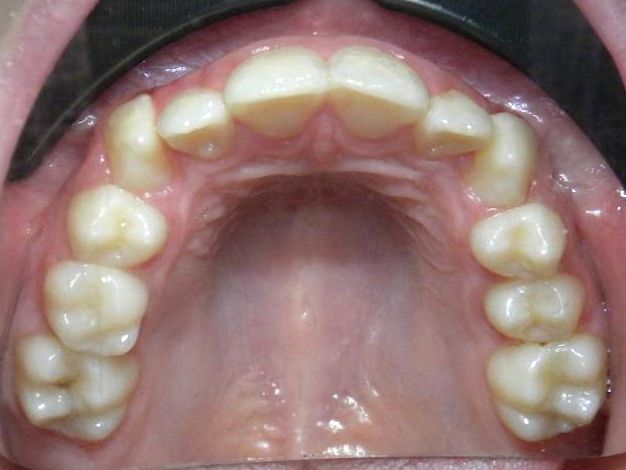 Oclusal Superior