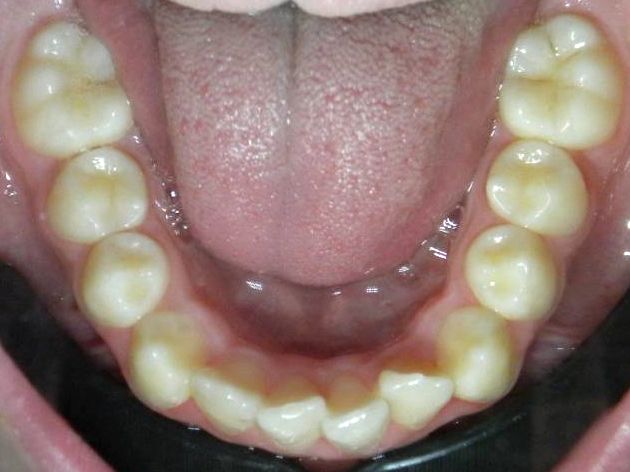 Oclusal Inferior