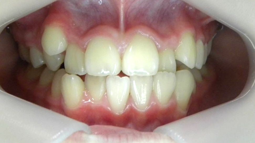 Frontal (Oclusión)
