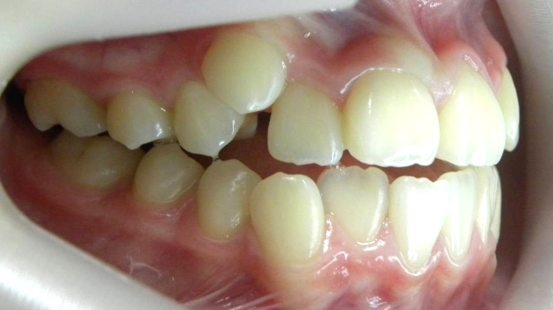 Lateral Derecha