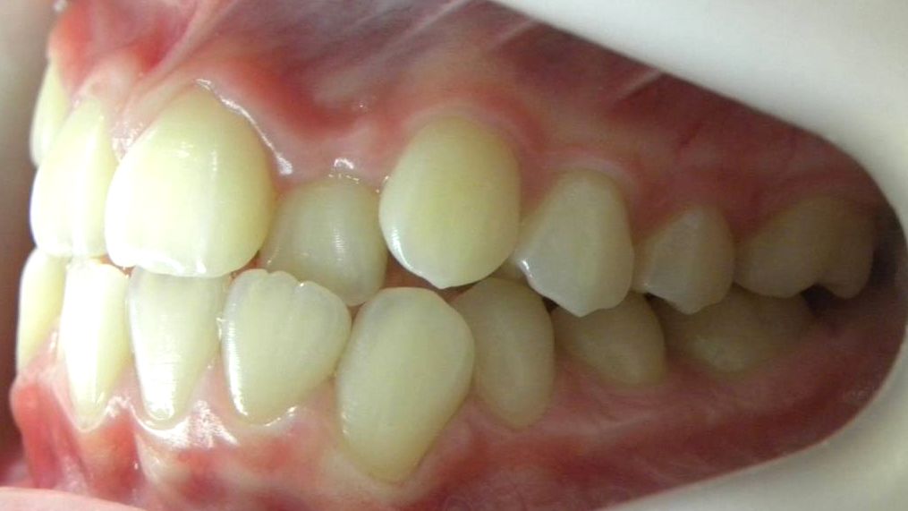 Lateral Izquierda