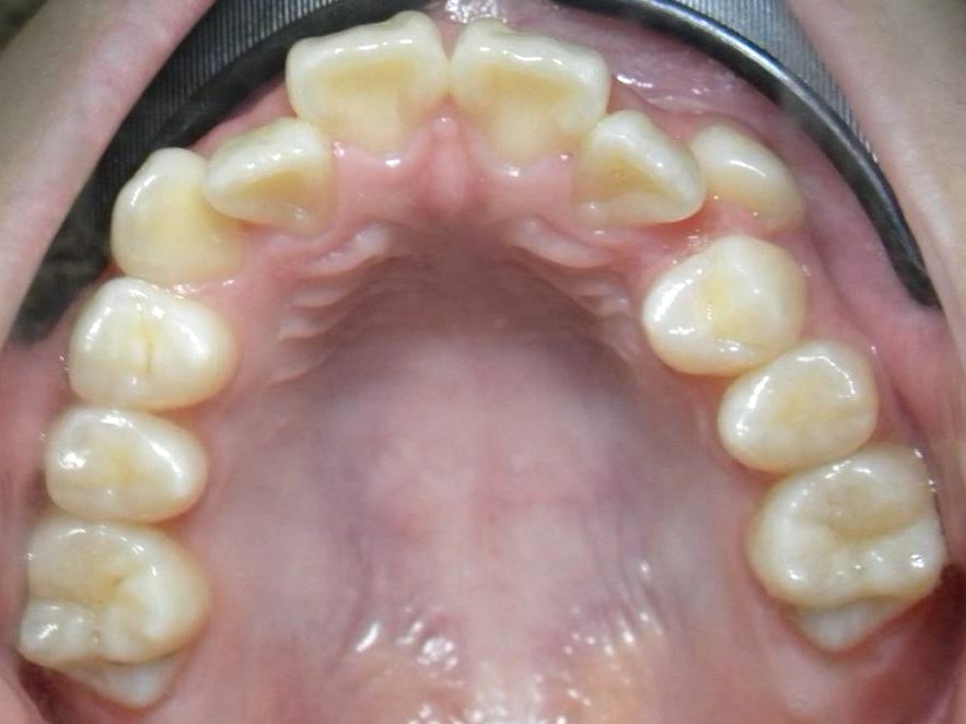 Oclusal Superior
