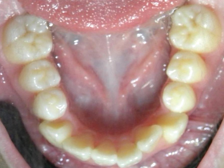 Oclusal Inferior
