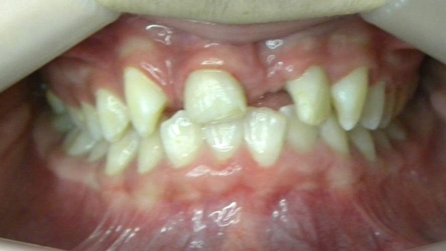 Frontal (Oclusión)