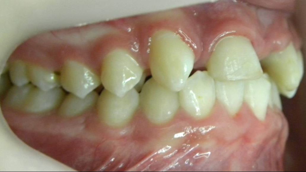 Lateral Derecha