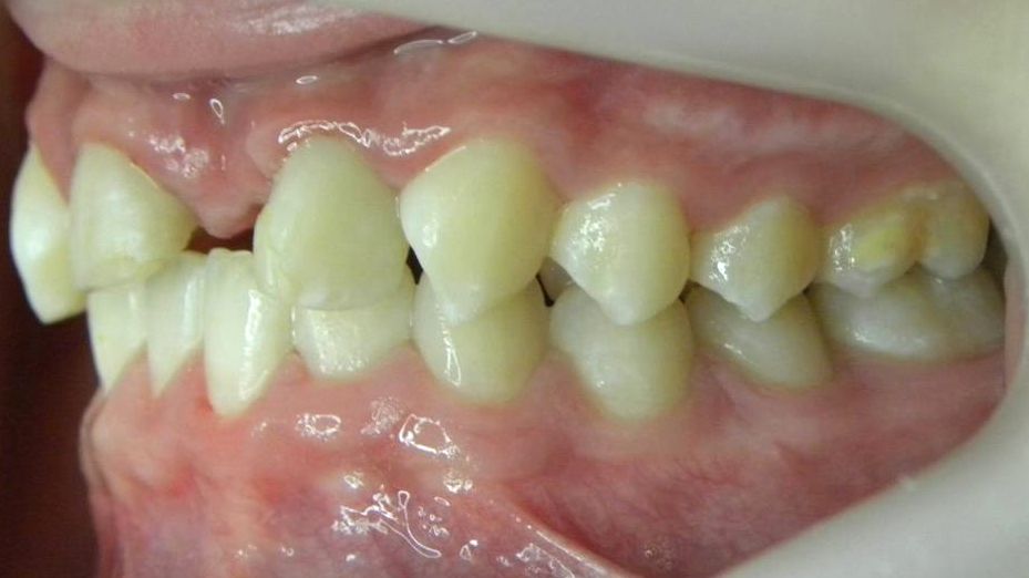 Lateral Izquierda