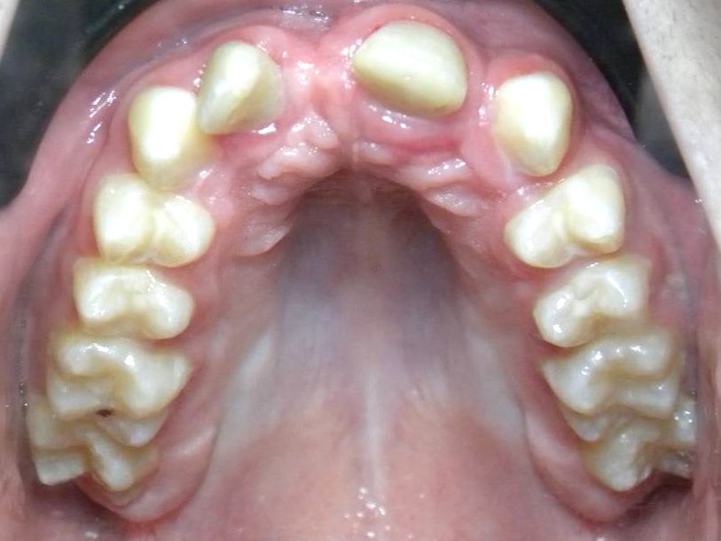 Oclusal Superior