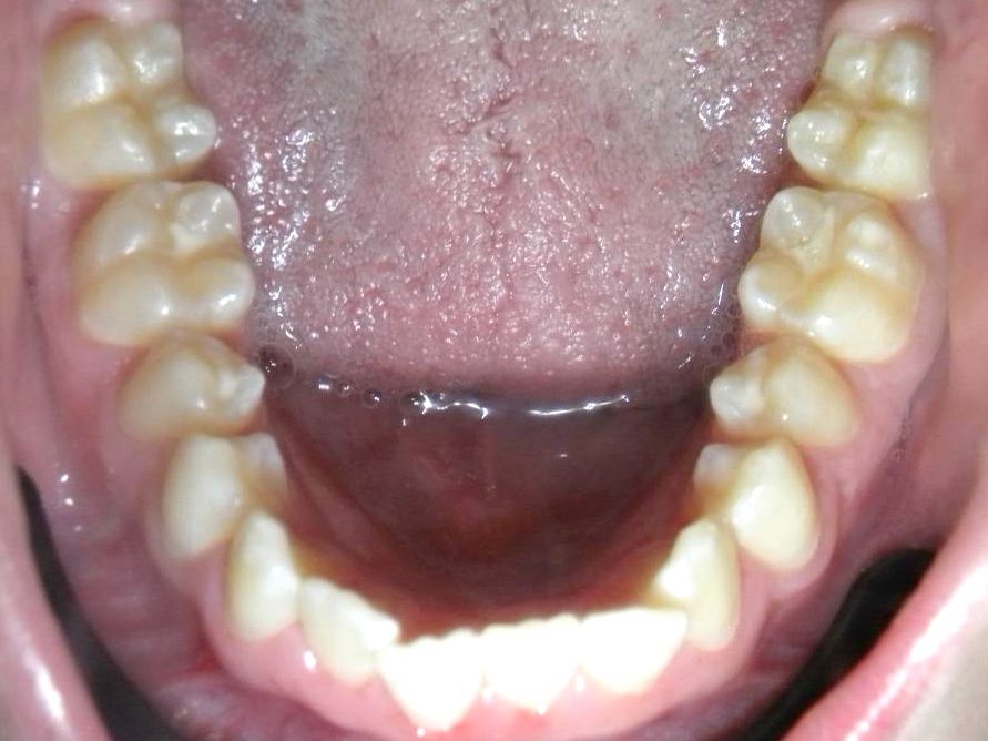 Oclusal Inferior