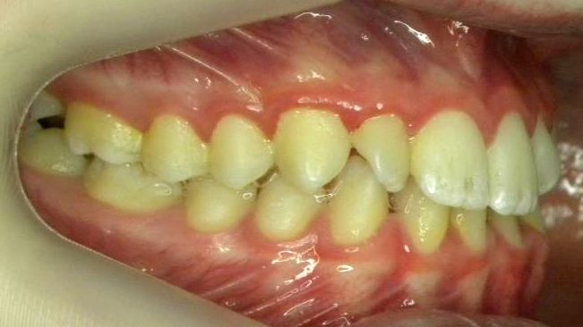 Lateral Derecha
