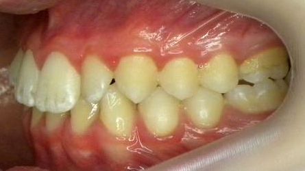 Lateral Izquierda