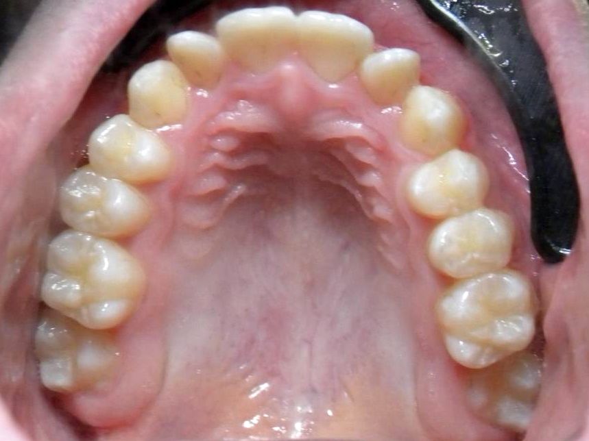 Oclusal Superior
