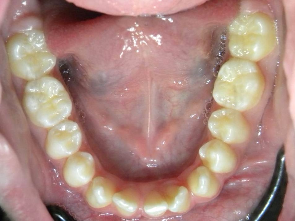 Oclusal Inferior