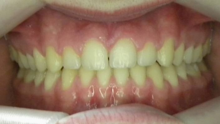 Frontal (Oclusión)