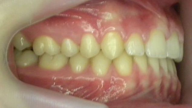 Lateral Derecha