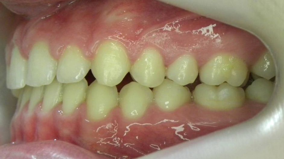 Lateral Izquierda