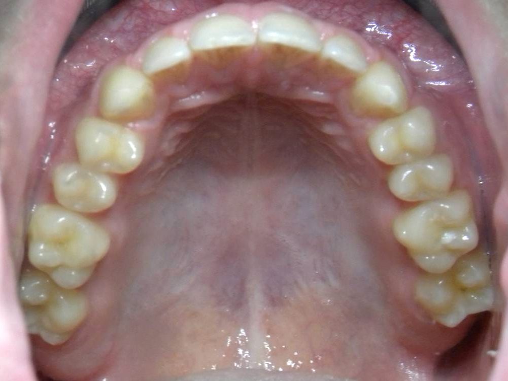 Oclusal Superior
