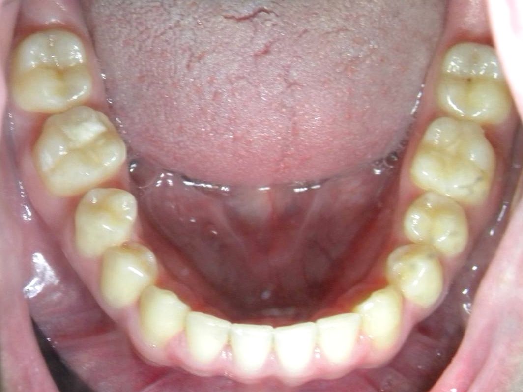 Oclusal Inferior