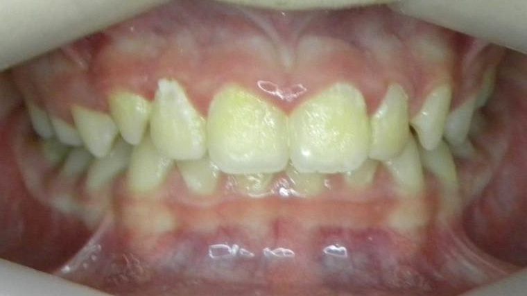Frontal (Oclusión)