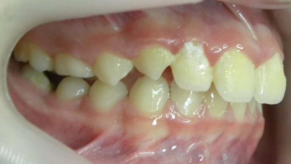 Lateral Derecha
