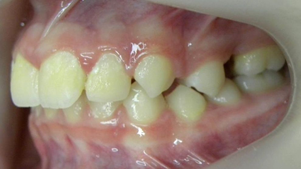 Lateral Izquierda
