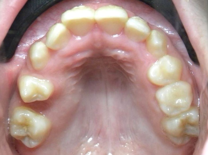 Oclusal Superior
