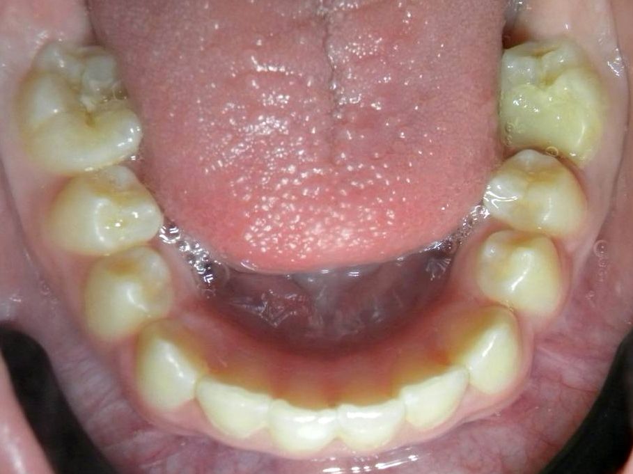 Oclusal Inferior