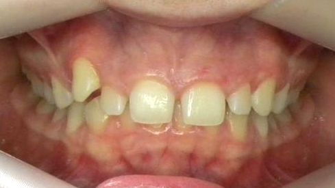 Frontal (Oclusión)