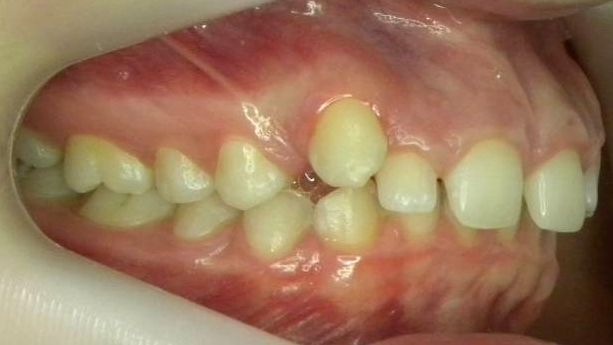 Lateral Derecha