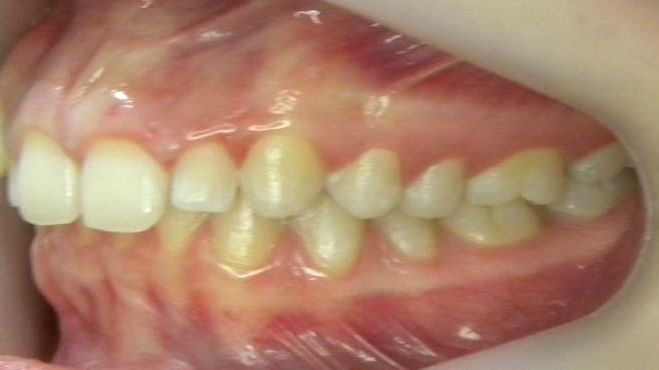 Lateral Izquierda