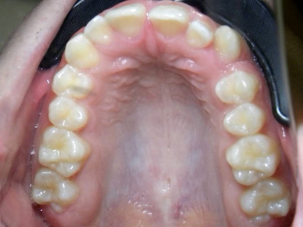 Oclusal Superior