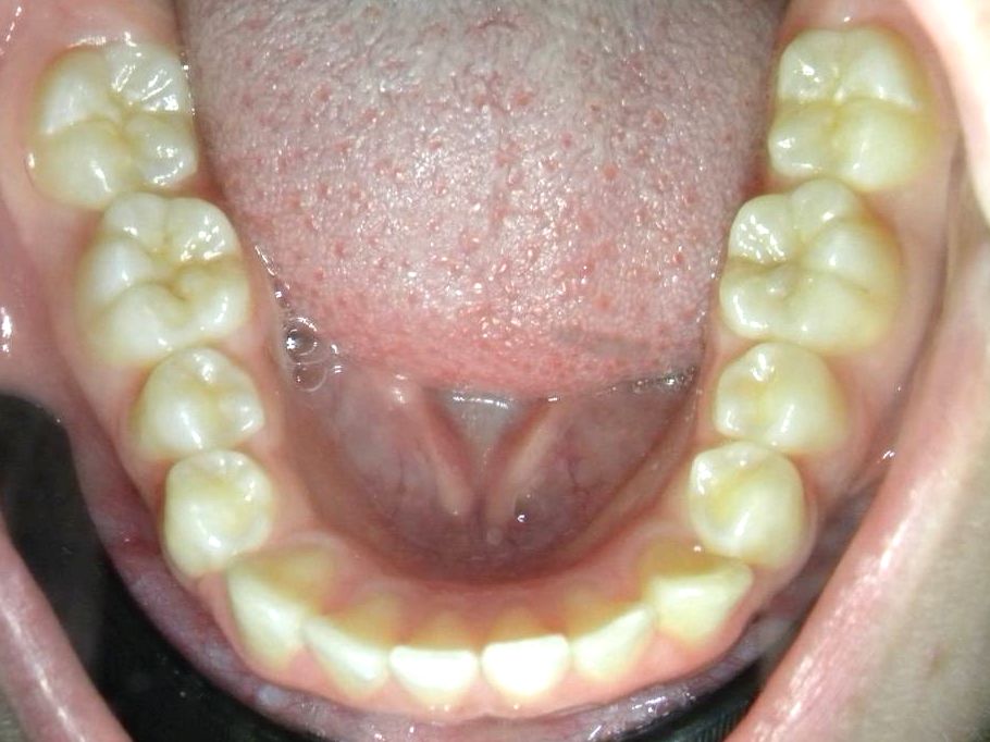 Oclusal Inferior