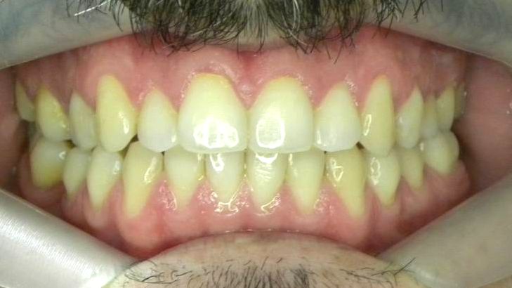 Frontal (Oclusión)