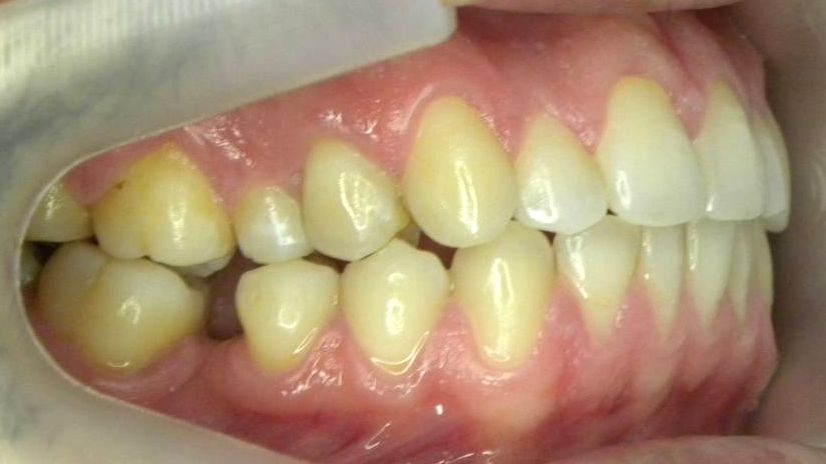 Lateral Derecha