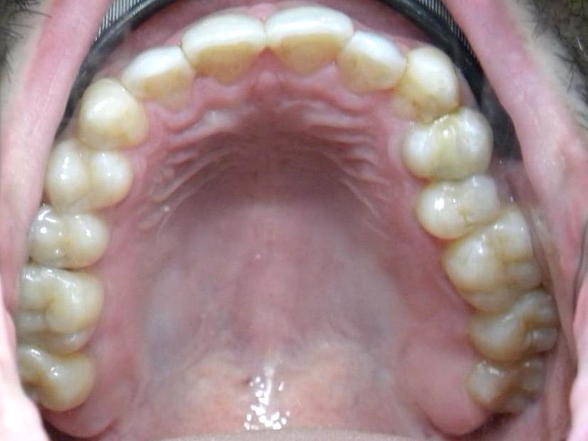 Oclusal Superior