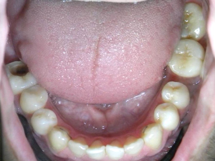 Oclusal Inferior
