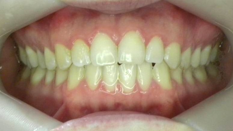 Frontal (Oclusión)