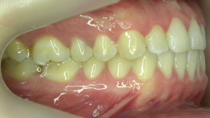 Lateral Derecha