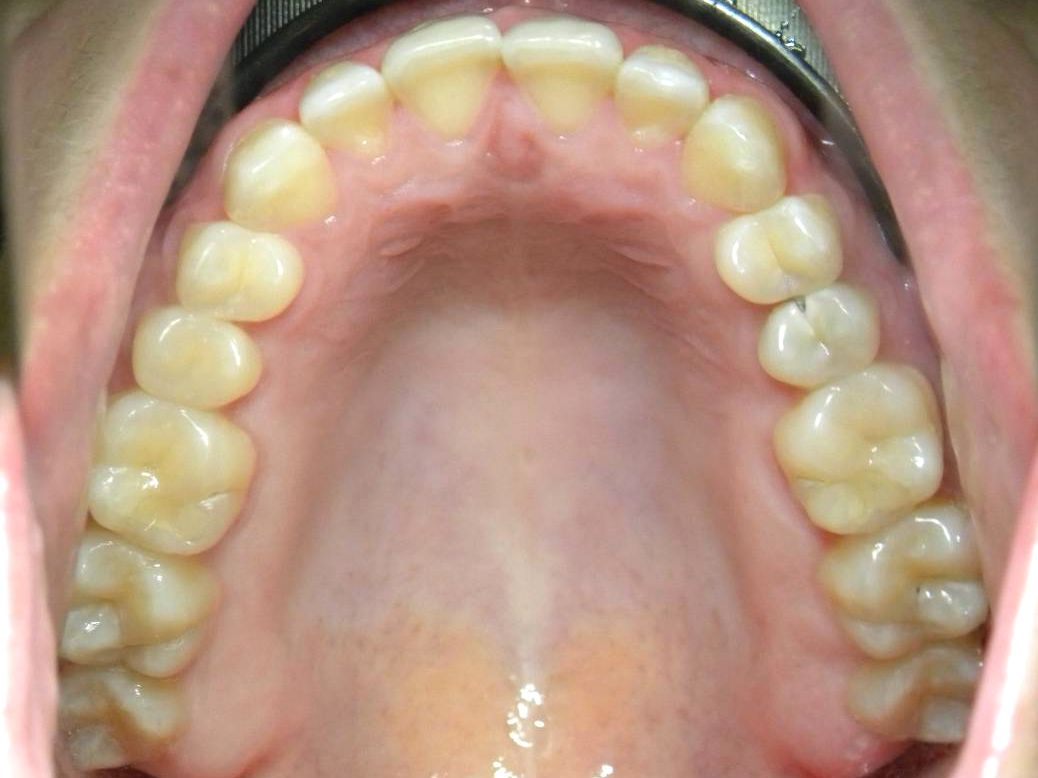 Oclusal Superior