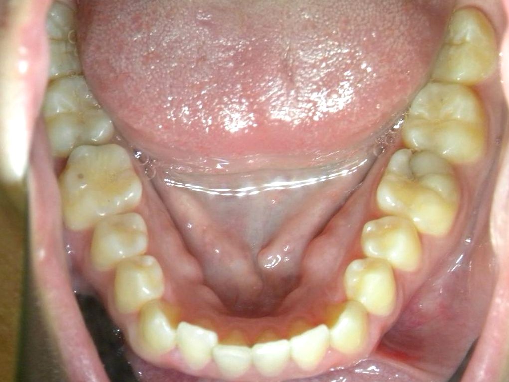 Oclusal Inferior