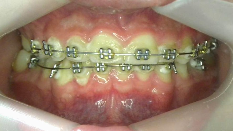 Frontal (Oclusión)