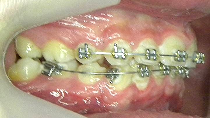 Lateral Derecha