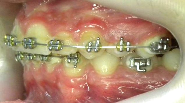 Lateral Izquierda